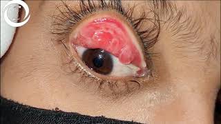 Giant Papillary Conjunctivitis [upl. by Tnahs]