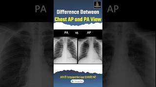 Difference between Chest AP amp PA view apview paview ChestAP Chestpa testpaperlive xray [upl. by Herm]