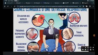 UE1 Sémiologie respiratoire  Les Signes fonctionnels Part 1 La Dyspnée [upl. by Ingeborg]