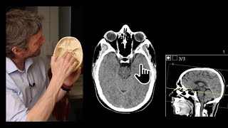 Paranasal sinuses CT imaging anatomy [upl. by Aissenav]