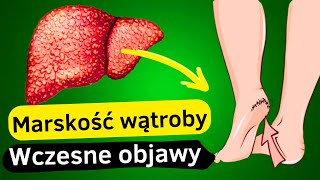 12 Pierwszych Objawów Uszkodzenia Wątroby  Przewodnik po Zdrowiu Wątroby [upl. by Ueik]