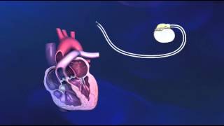 Implantatie van een tweekamerpacemaker  Medtronic [upl. by Lodge]