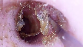 Cotton Bud Causing SEVERE Fungus Infection [upl. by Rehteh]