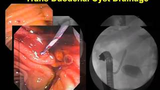 Innovations in Surgery  Ep 7 Minimally Invasive Management of Pancreatic Pseudocysts [upl. by Notla]