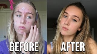 FROM SPOT TO HOT My Acne Story [upl. by Karilynn]