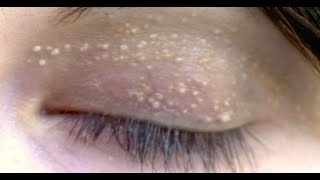 How To Remove Pimples On Eyelids Home Remedy Get Rid Of Stye On Eyelid Overnight [upl. by Bible161]