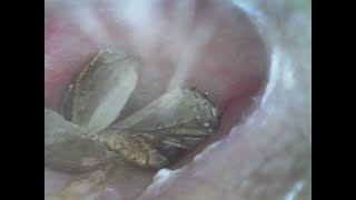 Live Insect in the Ear Endoscopic removal [upl. by Eynobe]