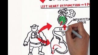 Pulmonary edema USMLE step 1 [upl. by Leibarg876]