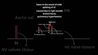 Heart sounds Wide splitting of S2 [upl. by Robins]