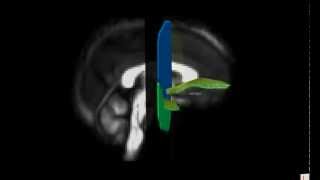 Delineation of the Uncinate Fasciculus [upl. by Kuhlman107]