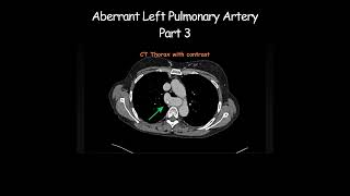 Aberrant Left Pulmonary Artery Part 3 radiology radiologist anatomy [upl. by Acinoryt]