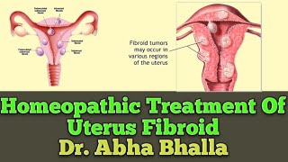 Homeopathic Treatment Of Uterus Fibroid  Dr Abha Bhalla [upl. by Anecusa]