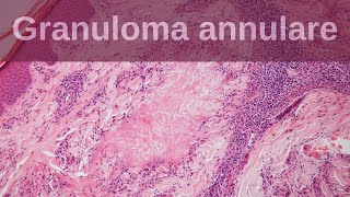 Granuloma Annulare  Pathology mini tutorials [upl. by Madora]