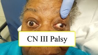 CN III Palsy [upl. by Aisayn531]