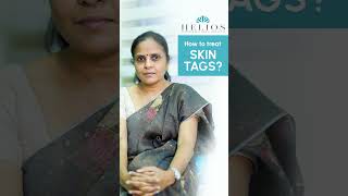 How to treat Skin Tag  Skin Tag removal  TAMIL  Dr Yamini  Helios skin hair amp laser clinic [upl. by Robert204]