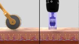 DERMAPEN SISTEMA DE REMODELACIÓN TISULAR [upl. by Bedell]