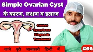 simple ovarian cyst  causes sign amp symptoms treatment  सिम्पल ओवेरियन सिस्ट के कारण लक्षण व इलाज [upl. by Quenby]