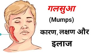 Mumps क्या है इसके लक्षण क्या है कारण क्या है और इलाज क्या है  Mumps Treatment in Home Remedies [upl. by Cavil]