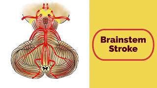 Brainstem Stroke Syndromes [upl. by Annaeel]