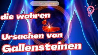 Gallensteine  das solltest Du wissen [upl. by Yrrek102]