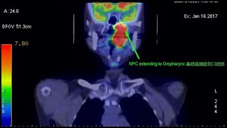 Advanced Nasopharyngeal Cancer  NPC PET CT scan 拒絕治療的鼻咽癌 正子電腦斷層掃描 [upl. by Saxe925]