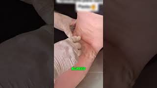 Can a Bee Cure Varicose Veins 😱 [upl. by Ocirled202]