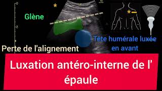 Luxation antérointerne de lépaule Glénohumérale Échographie [upl. by Yanrahs961]