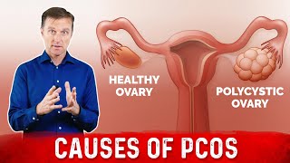 3 Causes of Polycystic Ovarian Syndrome PCOS amp High Androgens – Dr Berg [upl. by Gildas]