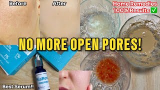 How to get Rid of Large Open Pores Best Home Remedies  Abial openpores [upl. by Winnifred100]