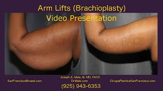 Brachioplasty SF Bay Area Arm Lifts and Arm Skin Tightening  10 [upl. by Nynahs]