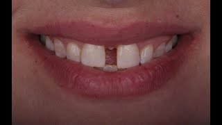 A combined approach for diastema closure [upl. by Eiramait368]