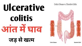 Ulcerative colitis  Traetment and Symptoms  Colistis ko theek kaise kare [upl. by Monk346]