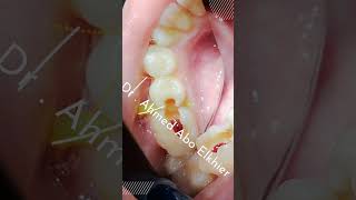 Single Visit Endodontic Treatment الكربولة endodontics dental [upl. by Enelyt]