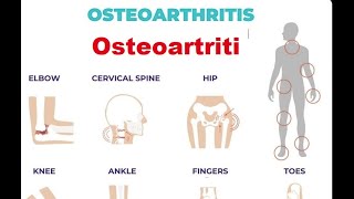 Osteoartriti është semundje [upl. by Morganica88]