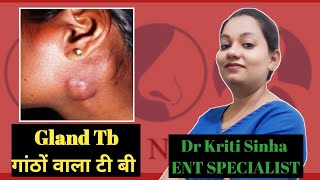 Gland Tuberculosis गाठो वाला टी बी कारण एवं उपाय SATYAEYEANDENTCARE drkritisinha [upl. by Bottali]