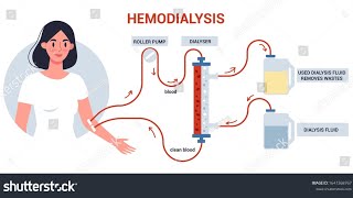 Que es la hemodiálisis Como se realiza Accesos vasculares y entre otras [upl. by Verda]