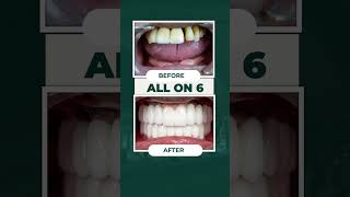 All On 6 The Perfect Lifetime Solution for Missing Teeth [upl. by Noemys542]