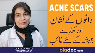 Remove Pimple Marks From Face  Danon Ke Nishan Khatam Karne Ki Tips  How To Get Rid Of Acne Scars [upl. by Mook291]