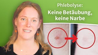 Stielwarze entfernen durch sanfte Verödung mit Phlebolyse ein Erfahrungsbericht gesundheit [upl. by Scammon]