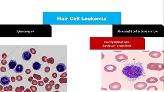 aplastic anemia part 2 diagnosis differential diagnosis treatment [upl. by Ire817]