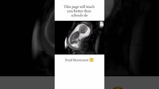 FETAL MOVEMENT😃 short youtubeshorts medical neet [upl. by Hgieliak]