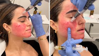 Getting the Vampire Facial 💉 You gotta see these results [upl. by Aynatal490]