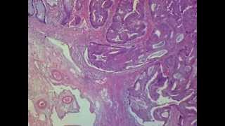 Pathology Video Colon adenocarcinoma under microscope 大腸癌切片病理影片。病理動画：顕微鏡画像下の大腸癌の病理。86MB33seconds [upl. by Cheslie]