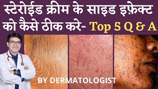 Steroid Cream side effects Treatment  कैसे ठीक करे  Top 5 QampA for Steroid Cream Side Effects [upl. by Donnamarie]