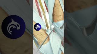 See how Extensor Tendon Injury of the Hand is and Repaired  3D Animation [upl. by Xenos928]