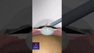 Cataract Surgery  3D Animation [upl. by Kehsihba311]