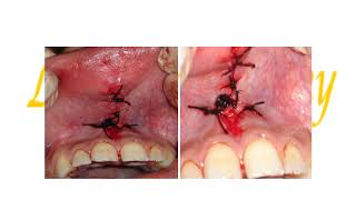 Preprosthetic sugery Soft tissues procedures [upl. by Ordnas]