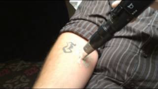 PicoSure Laser Tattoo Removal Demonstration in Toronto  SpaMedicaTV [upl. by Bobbette]