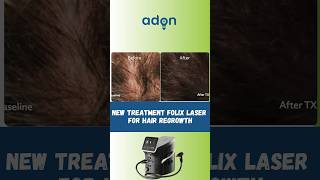 New 100 hair regrowth machine for male amp female  Hair fall  Hair loss viral shorts [upl. by Lancey594]