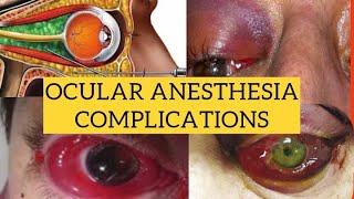 Complications of ocular anesthesia  Diagnosis and management [upl. by Eph]